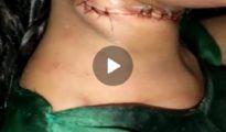 Banned nylon manja slits girl’s throat in Nagpur, survives after 26 stitches