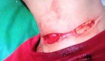 Nylon manja slits youth’s throat in Yashodhara Nagar