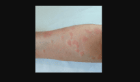 Beware: This skin disease is on the rise in Maharashtra!