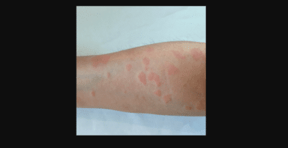 Beware: This skin disease is on the rise in Maharashtra!