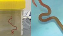 Surgeon finds live, wriggling worm in woman’s brain