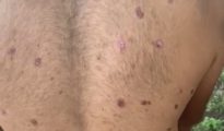 Nagpur Supari Agent Kidnapped; Alleged Perpetrators Torture Him with Cigarette Burns for Over Five Months