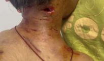 नागपूरच्या वाडी परिसरात भटक्या कुत्र्यांचा हैदोस; ६ वर्षीय चिमुकल्यावर जीवघेणा हल्ला!