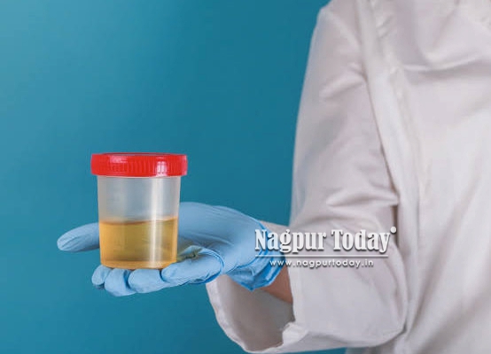 Suspecting a UTI? Why a Urine Culture Test Is More Important Than You Think