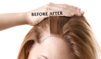Breakthroughs in Advanced Hair Treatments: What’s Really Working for Hair Loss Today?