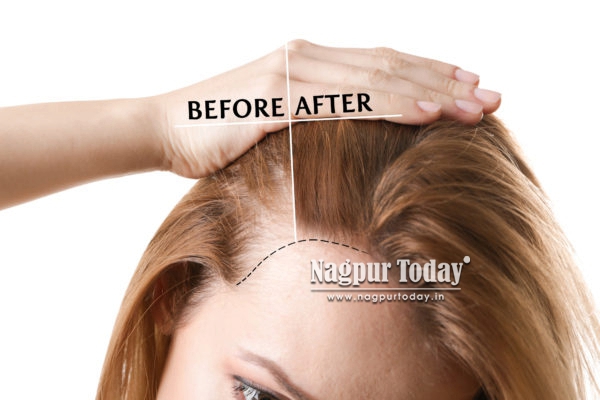 Breakthroughs in Advanced Hair Treatments: What’s Really Working for Hair Loss Today?