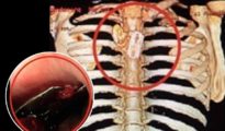 Medical miracle: Nagpur doctors remove razor blade from man’s food pipe!