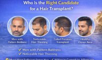 Who Is the Right Candidate for a Hair Transplant?